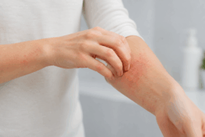 Dermatite de Contacto
