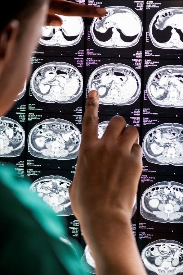 AVC (Acidente Vascular Cerebral)