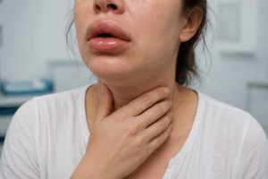 Angioedema