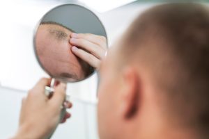 Alopecia