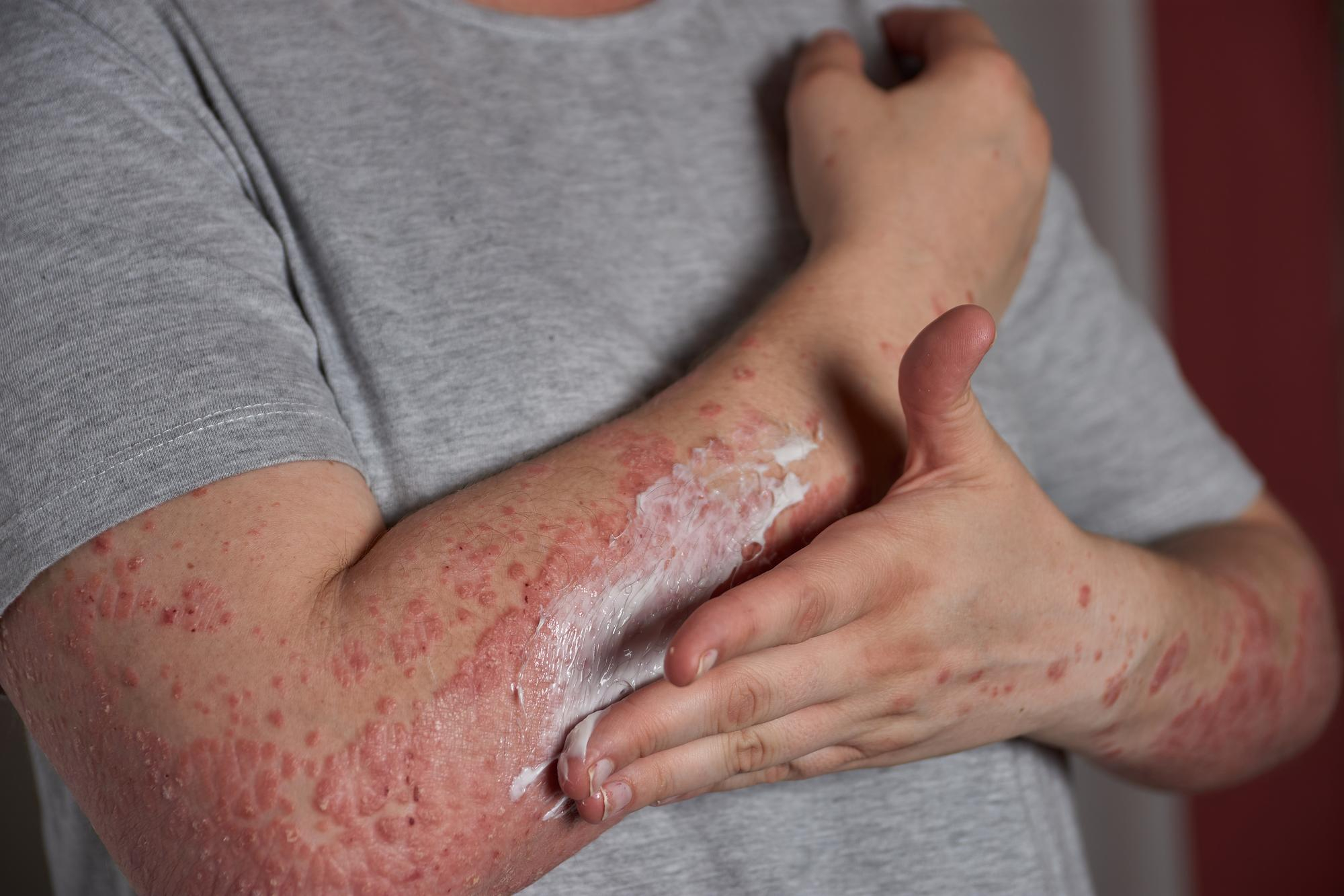 Lúpus Eritematoso Sistémico