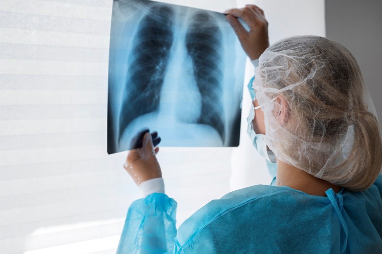 Enfisema