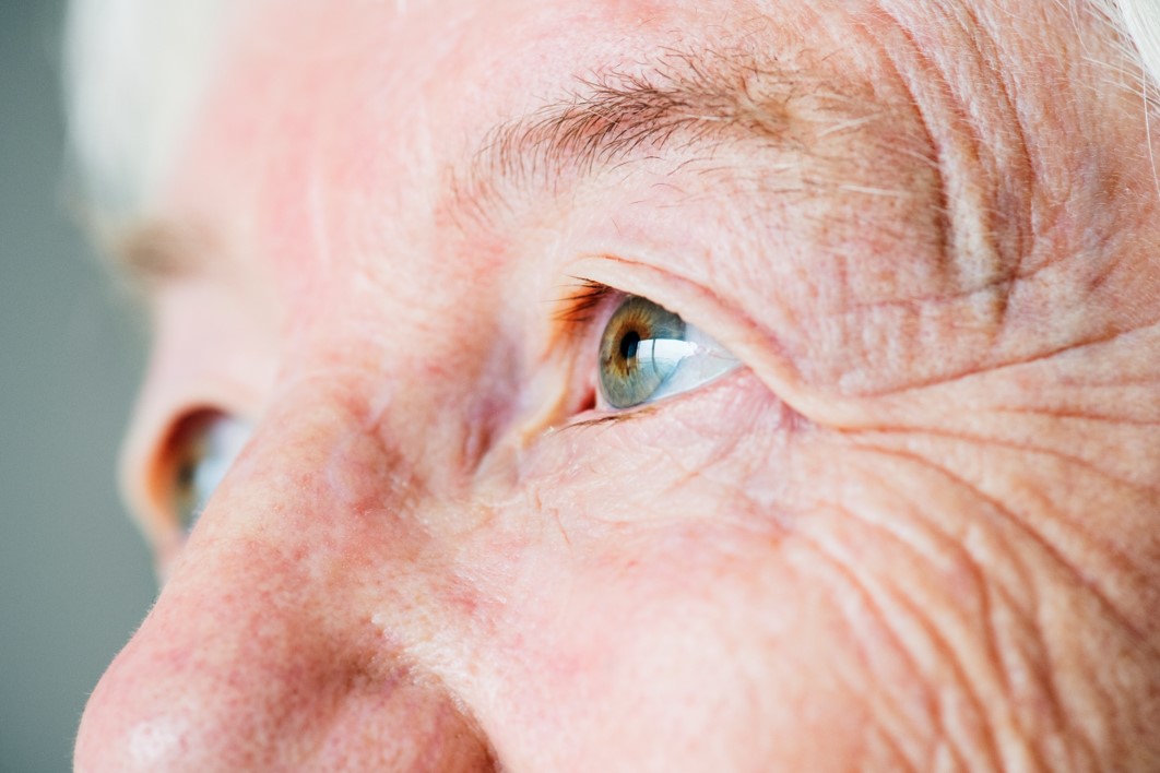 Glaucoma