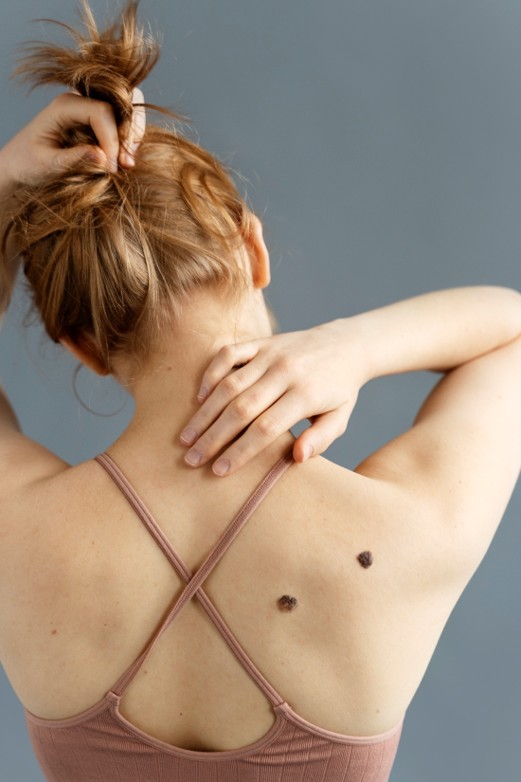 Cancro da Pele