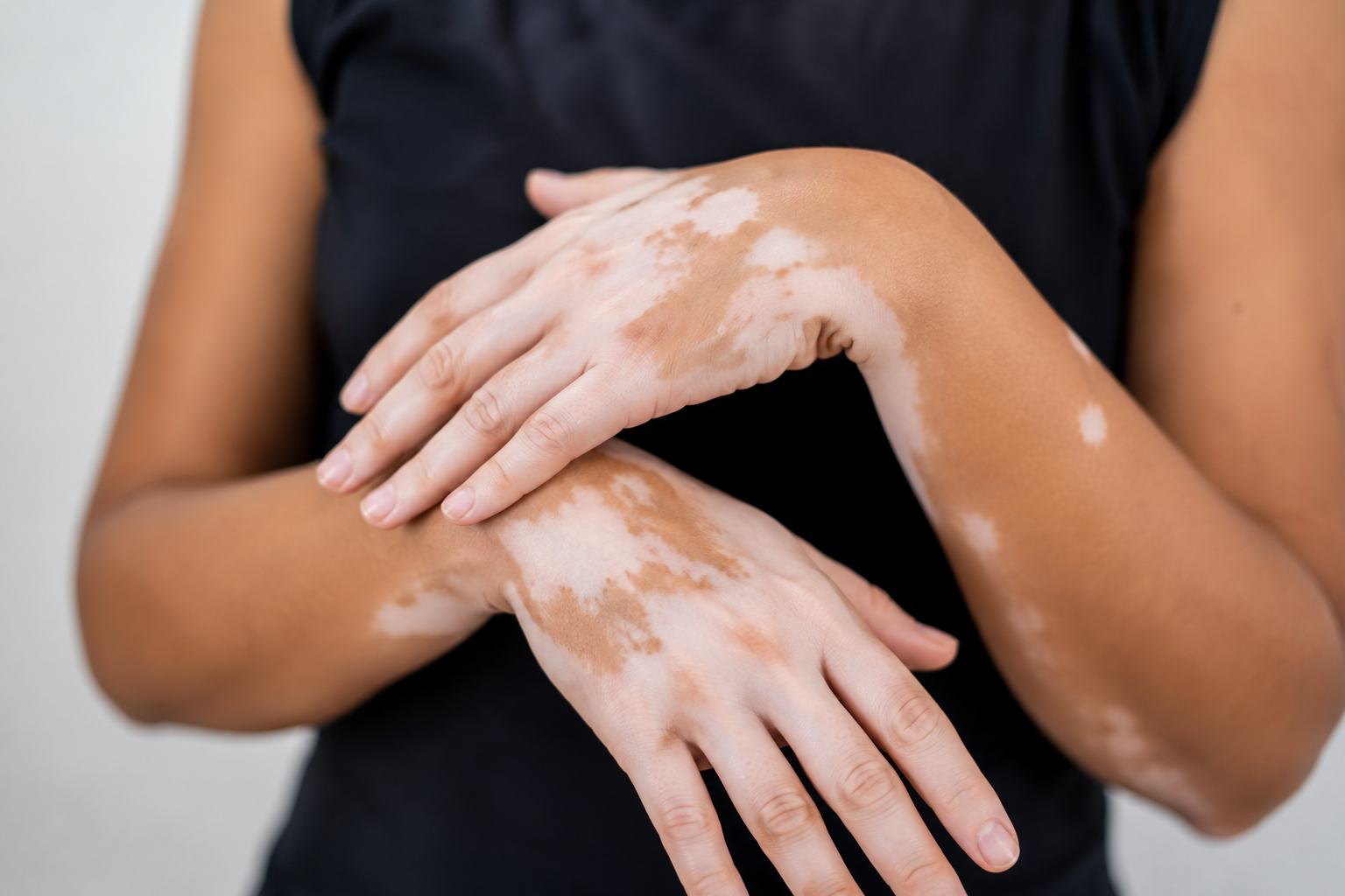 Vitiligo