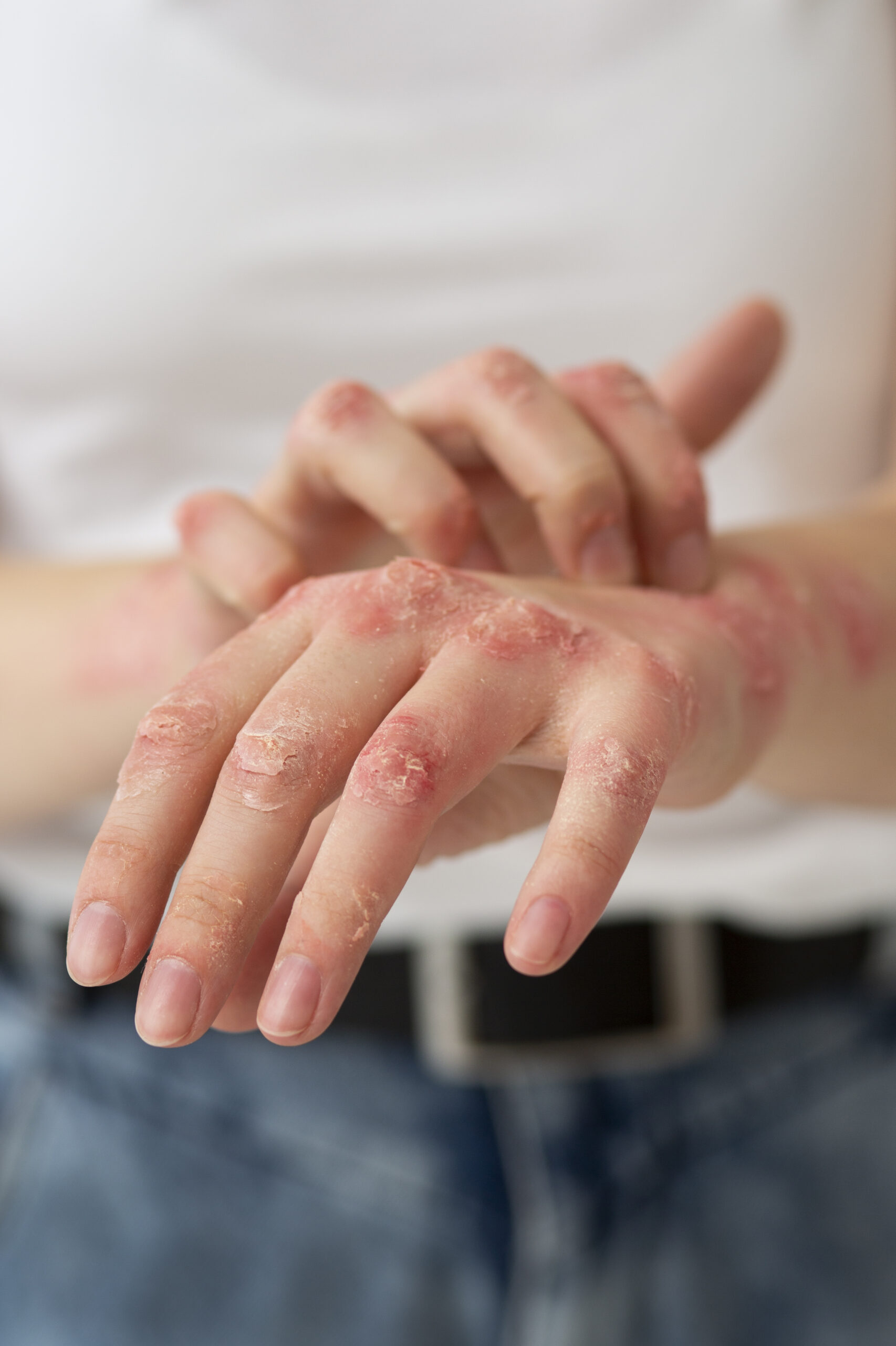 Impetigo