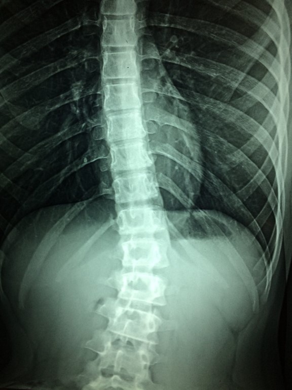 Escoliose