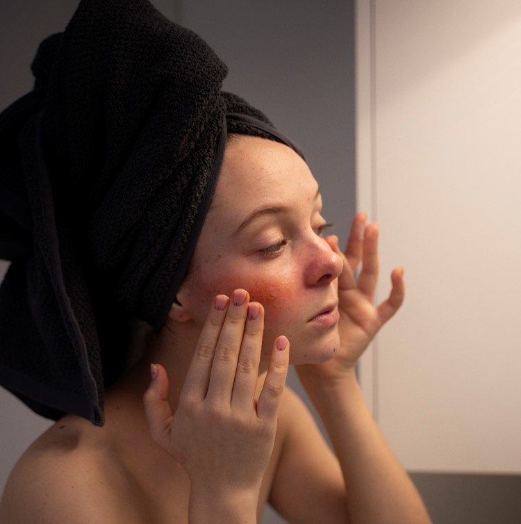rosacea