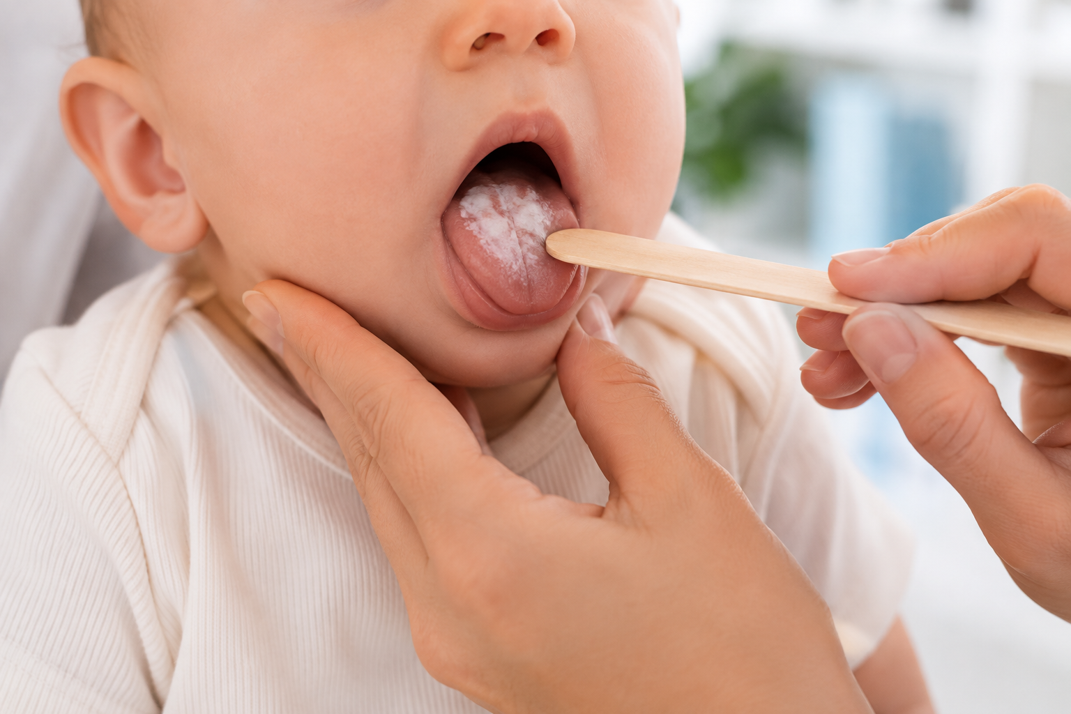 Candidíase Oral