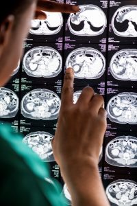 AVC (Acidente Vascular Cerebral)
