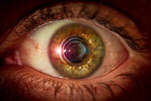 Retinopatia Diabética