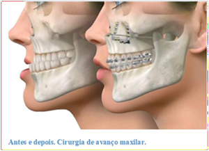Antes e depois da cirurgia de avanço maxilar