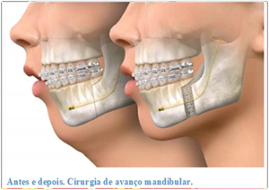 Antes e depois da cirurgia de avanço mandibular